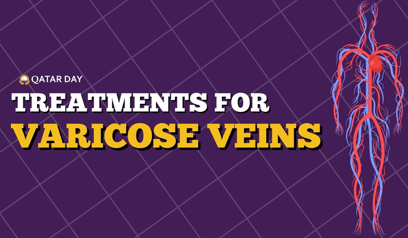 Treatments for Varicose Veins